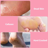 Foot File Callus Remover, Stainless Steel Pedicure Scrubber for Hard Cracked Dead Skin, Wet and Dry Foot Care, Pink In Australia - Darrahopens