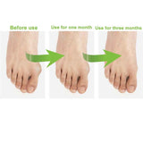 Onemayship Silicone Gel Toe Separator Orthotics Bunion Toes Spacer Pain Reliever 12Pcs