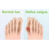 Onemayship Silicone Gel Toe Separator Orthotics Bunion Toes Spacer Pain Reliever 12Pcs