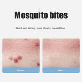 Bug Bite Itch Relief Tool USB Rechargeable Mosquito Bite Sucker Chemical Free for Bug Bites Bee Wasp Stings In Australia - Darrahopens