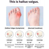 Darrahopens Health & Beauty > Personal Care > Foot Care Bunion Relief Sleeves Bunion Pads Brace Cushions Toe Straightener Hallux Valgus Relief Kit Pack (small)