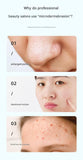 Darrahopens Health & Beauty > Skincare > Skincare Masks & Peels White Heated Micro-Bubble Blackhead Remover Vacuum Pore Cleaner - 46C Hot Compress Electric Water Cycle Facial Cleansing Device with 6 Suction Heads 3 Modes